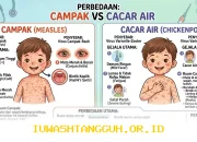 Peningkatan Kasus Campak di Indonesia 2026, Masyarakat Sering Salah Paham Tentang Penyakit Ini dengan Cacar Biasa